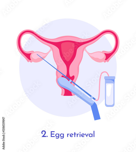 Medical diagram showing the egg retrieval process in assisted reproductive technology, flat graphic style, light background. Concept of IVF procedure. Vector illustration