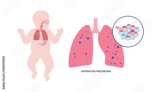 Aspiration pneumonia poster