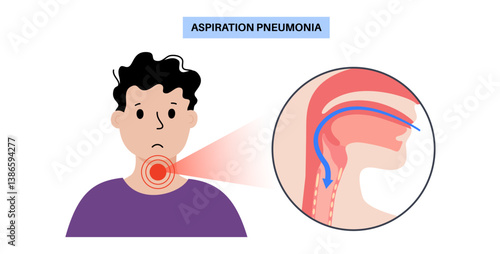 Aspiration pneumonia poster