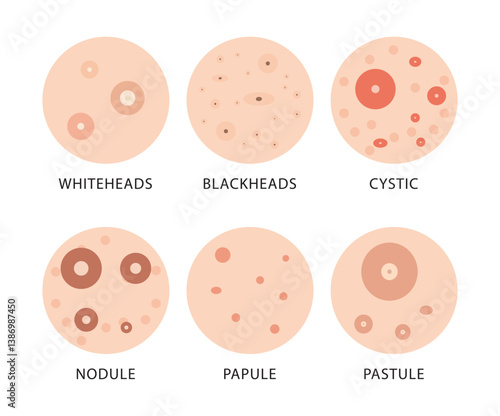  type of acne vecto design