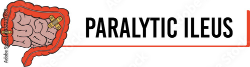 paralytic ileus