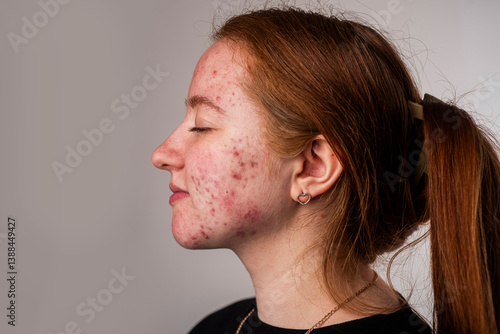 Obraz na plátne Many pimples