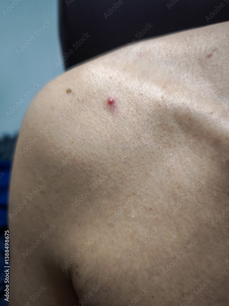 Fototapeta premium pimple on shoulder