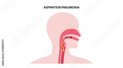 Aspiration pneumonia poster