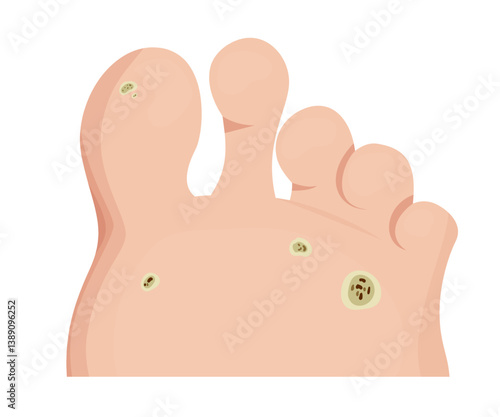 Plantar warts growing on the sole of a foot