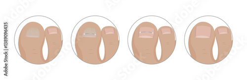 Podiatrist applying toenail correction staples step by step