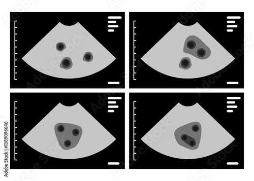 Ultrasound scan showing triplets pregnancy on monitor screen