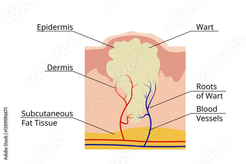 Wart virus infecting epidermis and dermis through blood vessels