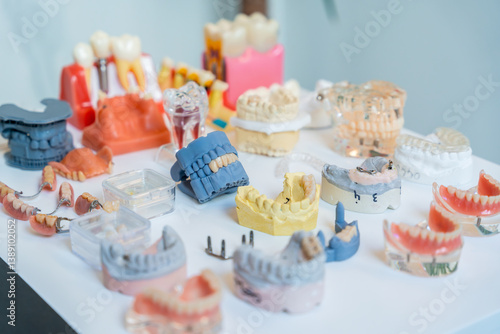 Dental models showing different types of teeth and implants on table