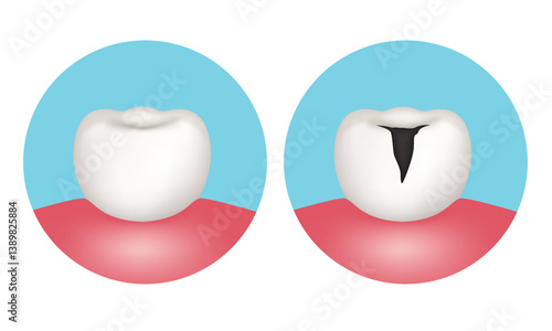 Tooth with and without caries. Anatomy of the tooth. Vector illustration.