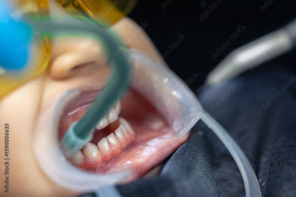 Obraz premium Close-up of a child's mouth during dental treatment. Dentistry. Dental treatment.