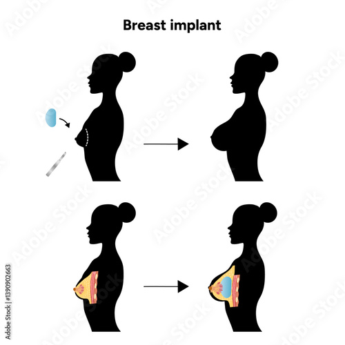 Women’s breast anatomy implant. Medical female diagram