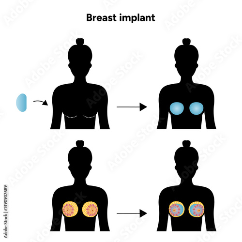 Women’s breast anatomy implant. Medical female diagram