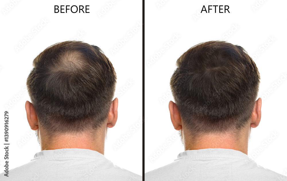 Man suffering from baldness on white background, back view. Collage with photos before and after treatment