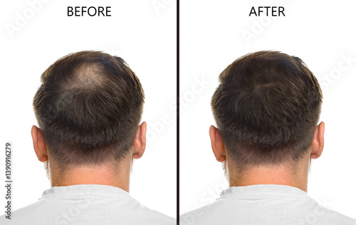 Obraz na płótnie Man suffering from baldness on white background, back view. Collage with photos before and after treatment w salonie