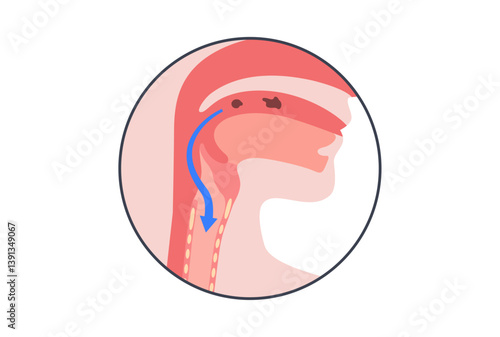 Aspiration pneumonia poster