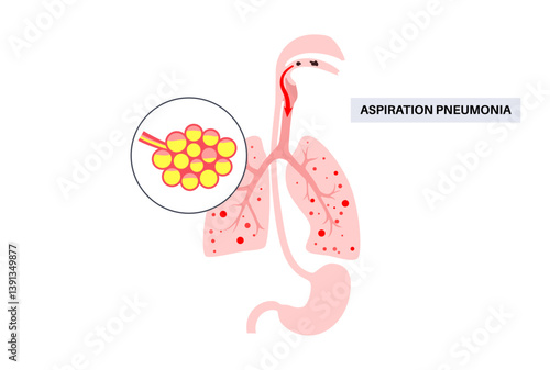 Aspiration pneumonia poster