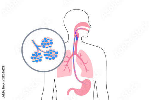 Aspiration pneumonia poster