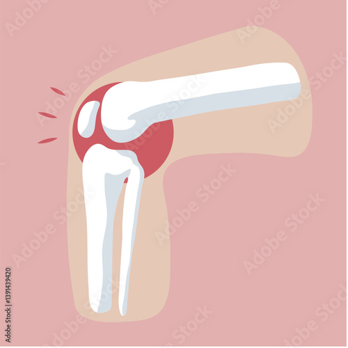 Knee pain caused by Osteoarthritis