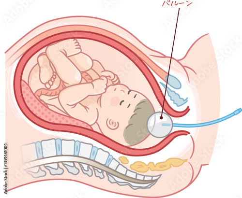 無痛分娩・バルーンのイラスト  Painless childbirth illustration