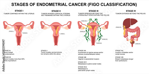 Endometrial cancer stages. FIGO classification of uterine cancer