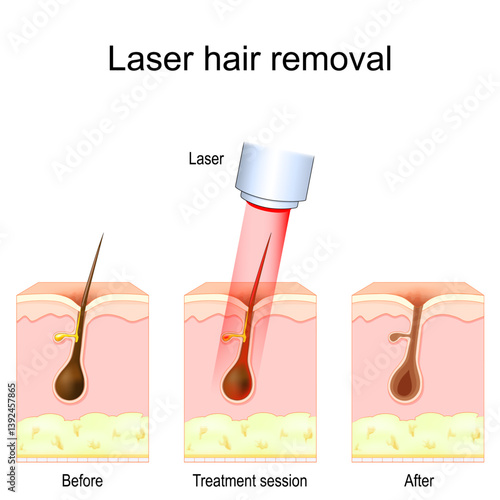 Laser hair removal