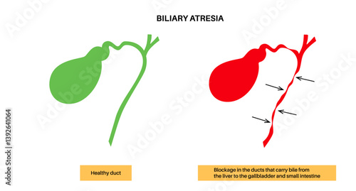 Biliary atresia disease