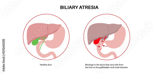 Biliary atresia disease