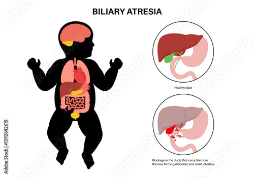 Biliary atresia disease