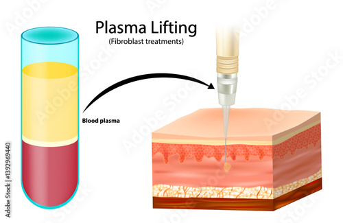 Plasma Lifting or Fibroblast treatments. Blood Plasma Injection Illustration for Rejuvenation. Medical Diagram of Plasma Lifting Procedure PRP therapy