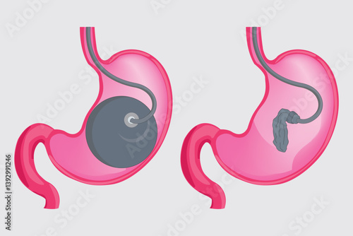 bariatrix ballon. medical illustration. eps 10