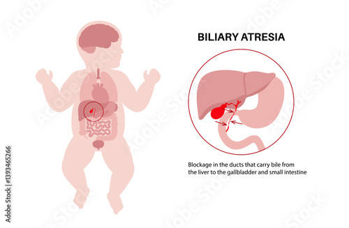 Biliary atresia disease