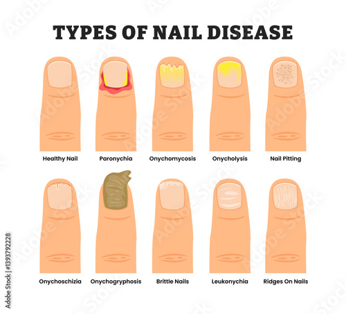 Different types of nail disease disorder types, educational medical poster design healthcare scheme, labeled healthy nail, paronychia, onychomycosis, onycholysis, pitting, brittle, leukonychia.