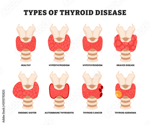 Different types of thyroid disease types, educational medical poster design healthcare scheme, labeled hyperthyroidism, hypothyroidism, graves disease, endemic goiter, cancer, adenoma, autoimmune.