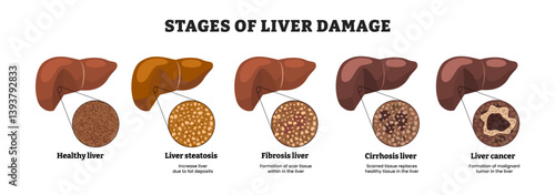 Stages of liver damage stages progress, educational medical poster design healthcare scheme, labeled healthy liver, steatosis, fibrosis, cirrhosis, liver cancer. Scar tissue. Human internal organ.