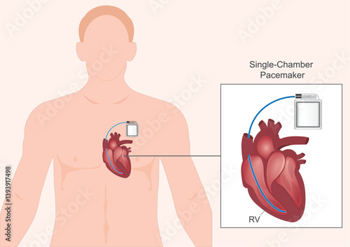 Single chamber pacemaker.Type of pacemaker.