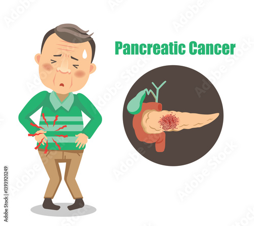 Man with Pancreatic Cancer Illustration