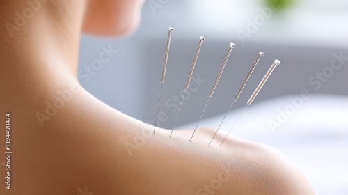 Acupuncture needles inserted in a person's shoulder for therapy.