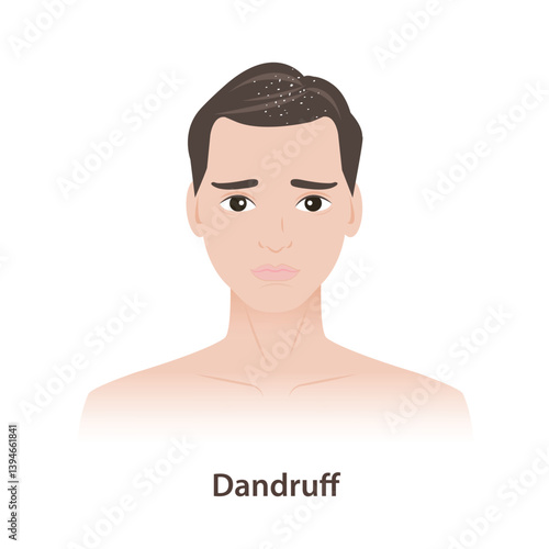 The man with dandruff in hair illustration. Dandruff is the skin on the scalp to dry flaky, itchy, white, yellowish flakes in hair, on shoulders. Scalp irritation, mild form of seborrheic dermatitis.