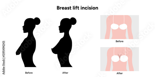 Women’s breast lift incision. Medical female diagram. Before and after