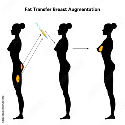 Women’s breast fat transfer augmentation. Medical female diagram