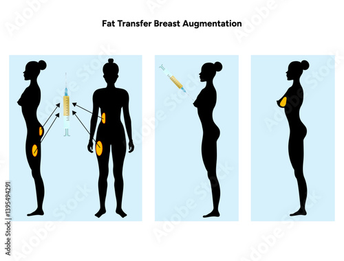 Women’s breast fat transfer augmentation. Medical female diagram