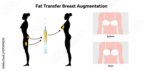 Women’s breast fat transfer augmentation. Medical female diagram