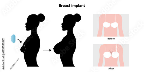 Women’s breast anatomy implant. Medical female diagram. Before and after