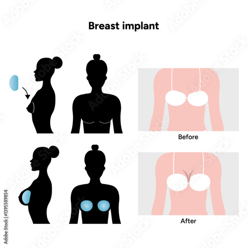 Women’s breast anatomy implant. Medical female diagram. Before and after