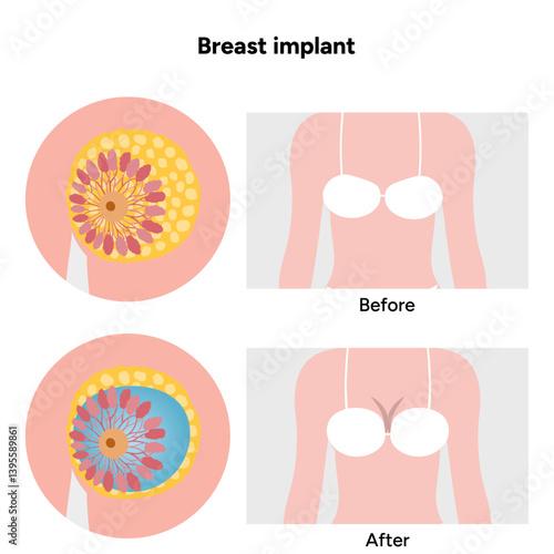Women’s breast anatomy implant. Medical female diagram. Before and after
