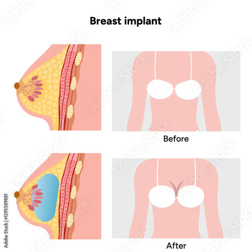 Women’s breast anatomy implant. Medical female diagram. Before and after