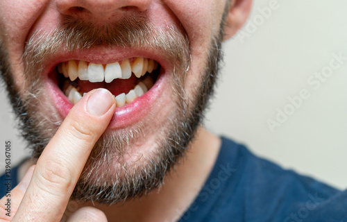 close up of a broken tooth, young adult showing teeh