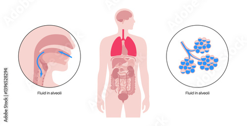 Aspiration pneumonia poster