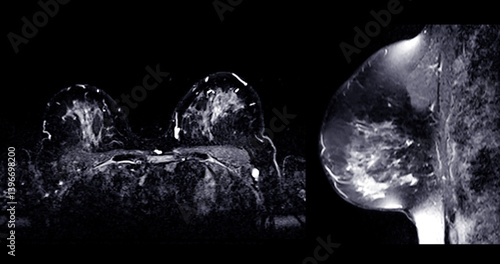 MRI scan of the breasts in an axial and sagittal view with contrast enhancement.
